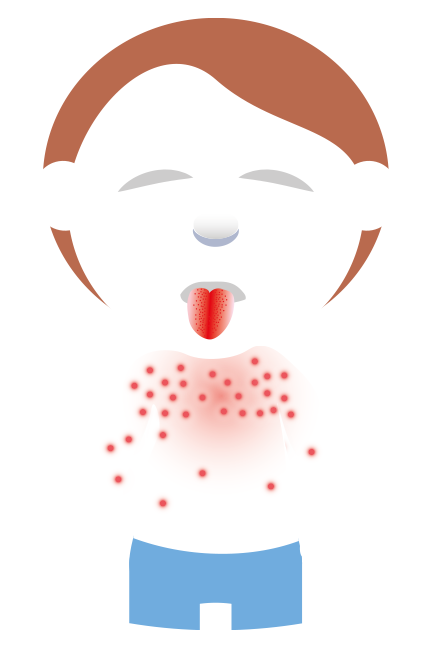 Illustration av ett barn som har en röd tunga och rödprickiga utslag på kroppen