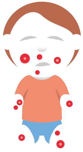 Illustration av ett barn som har höstblåsor
