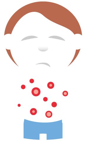 Illustration av ett barn som har blåsor och röda utslag på överkroppen